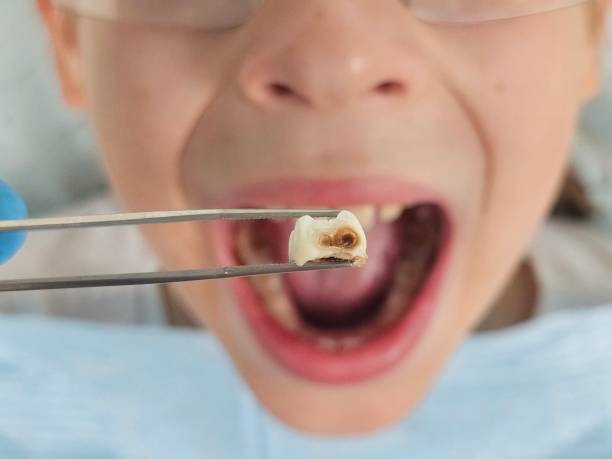 Best Emergency Treatment for Oral Infections in Abram, TX